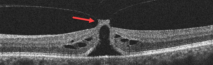 vmt_oct_focal
