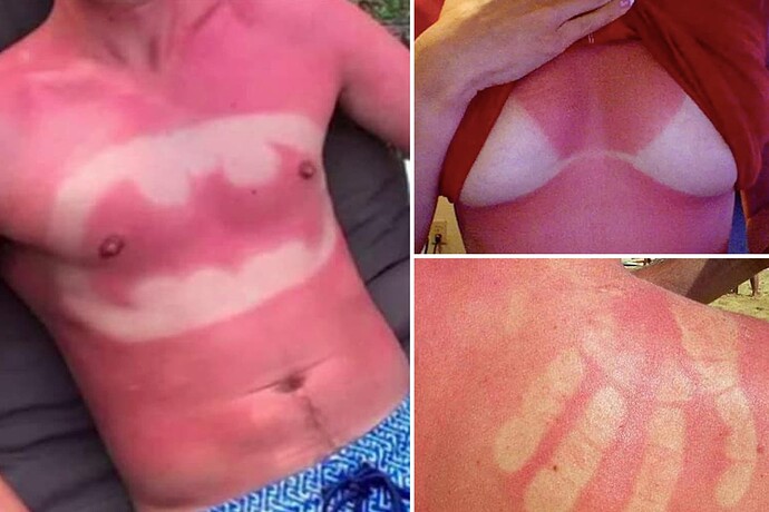AD-COMPOSITE-Sunburn